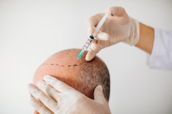 The number of men choosing to have a hair transplant is growing.