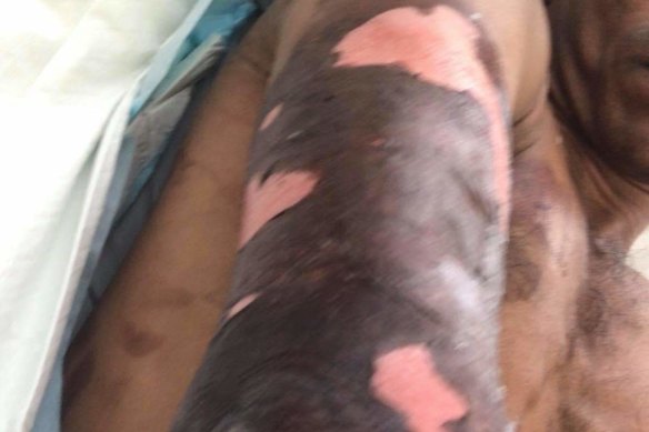 The injury to an unnamed Sri Lankan meatworker’s arm. He later lost his job.