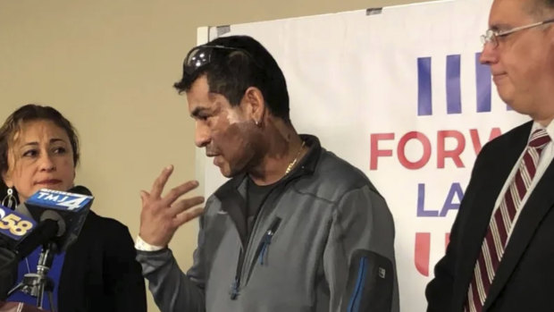 Mahud Villalaz, 42, of Milwaukee gestures to the second-degree burns on his face at a news conference one day after a man threw acid at him outside a restaurant.
