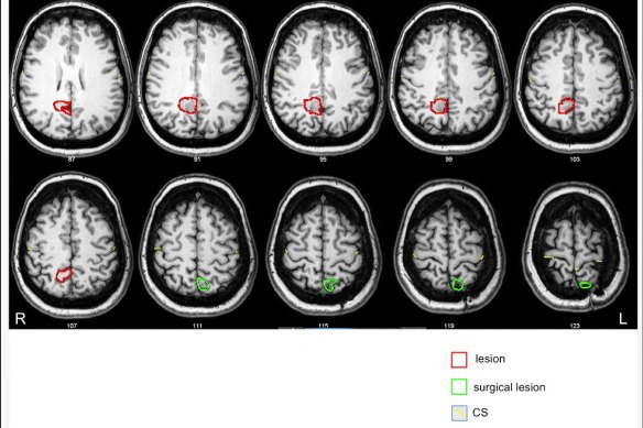 Michelle Smith’s 2014 brain scan. 
The red circles indicate the location of the brain tumour, while the green shows where Dr Charlie Teo operated.