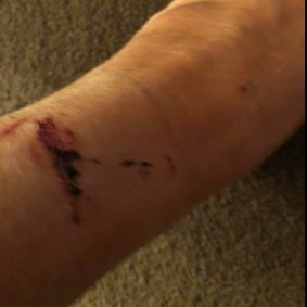 Cherie Meyer wounds from June 9, 2019 assault by ex-husband.