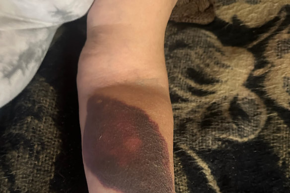 A woman’s arm was bruised after a fall in Sydney group home operated by Beyond Care.