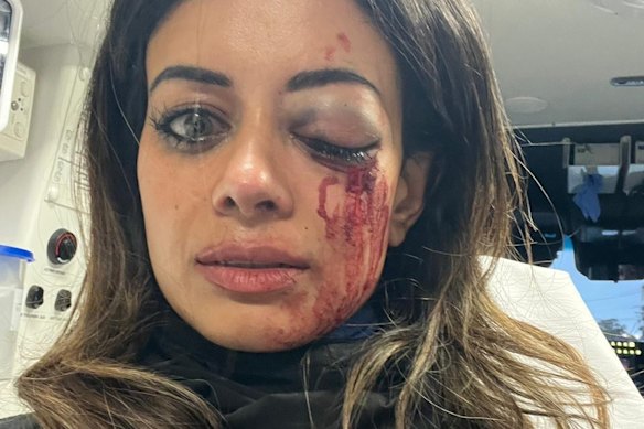 Hannah Thomas, with a bruised and swollen eye and a bloodied face, sits in an ambulance after being arrested during a protest in Belmore on Friday.
