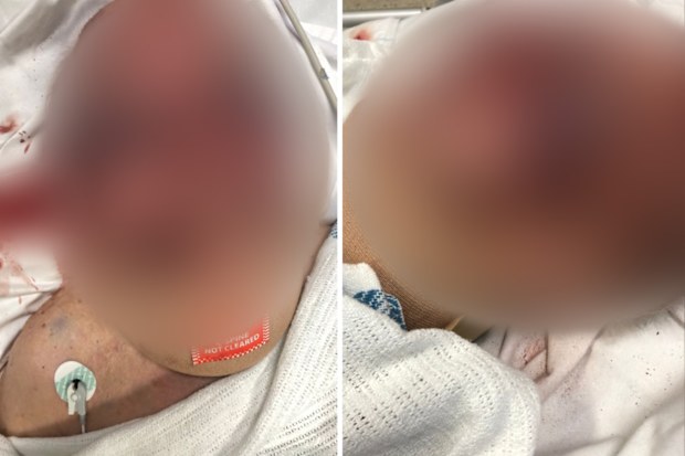 A blurred image of a man laying in a hospital bed after suffering serious injuries to his face.