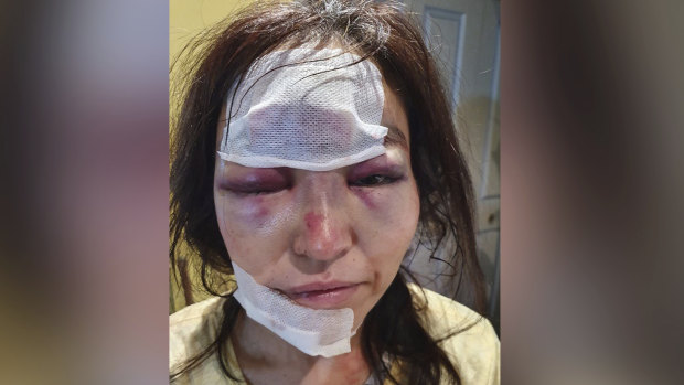 Mikato Pearce had to go to hospital for significant facial injuries after she was robbed on Wednesday night. 