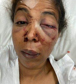 A photo supplied by the Greens, with Cr Mohamud’s consent, of her serious injuries.