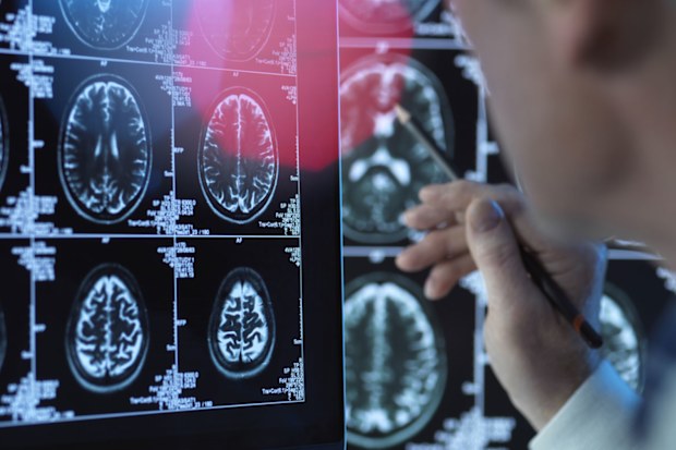 A new low-cost blood test could help detect Alzheimer's disease decades before symptoms appear.