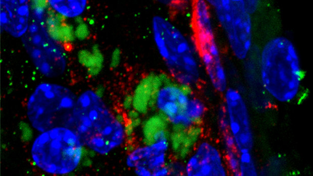 The bacterium Chlamydia pneumoniae (green) in the olfactory bulb region of the front of the brain. Beta amyloid peptide (red) accumulates around the bacteria. Blue indicates nuclei of cells of the brain.