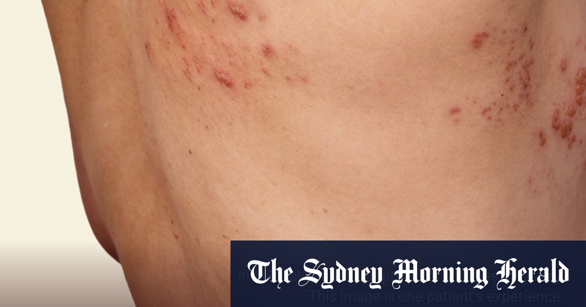 Shingles myths, busted: What every Australian needs to know