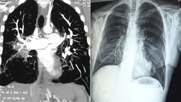Adam Wells' lungs before his double lung transplant, and after. 
