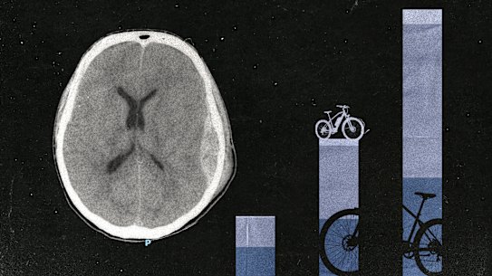 An anonymised scan, taken around 2am on a Sunday morning last year, shows a traumatic brain injury suffered by a St Vincent’s patient involved in an e-bike accident.