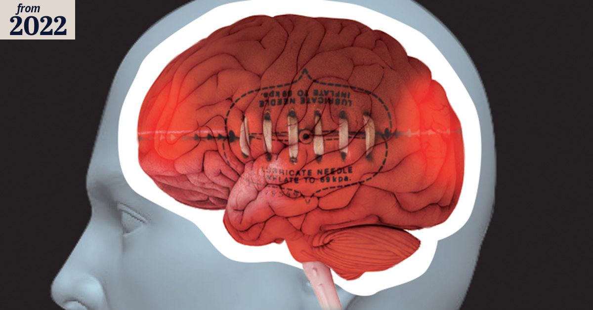 CTE found in more than half of donated brains: study