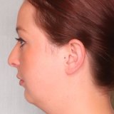 Emmah Forrest's chin before she had the surgery. 