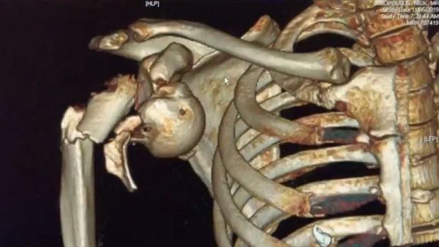 A medical scan showing Nik Dimopoulos' injuries.