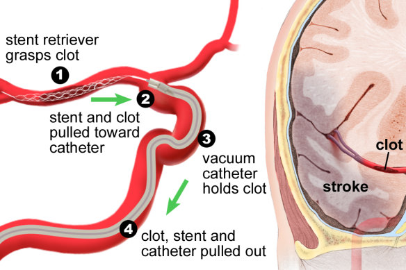 How endovascular clot retrieval works.