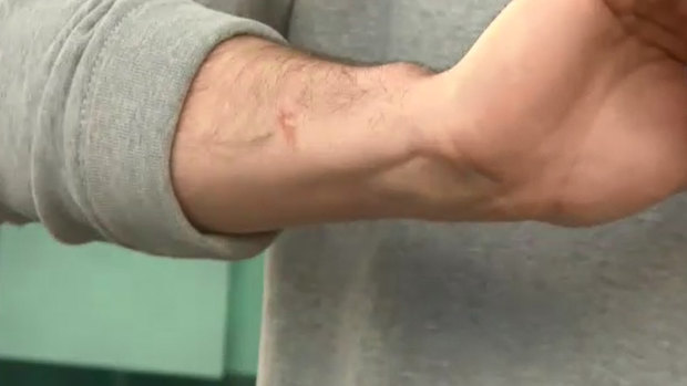 A close-up of Alex Kimberley’s arm. 