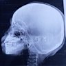 Doctors say the shrapnel in the head of Hodan Abby’s five-year-old daughter needs to be removed.