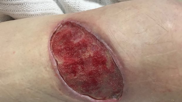 Donald Cottee’s ulcer grew to more than 10 centimetres after he was bitten by a mosquito almost a year ago. 