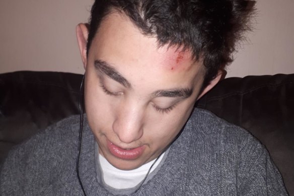 An image of the head injury James Wheatley suffered in respite care.