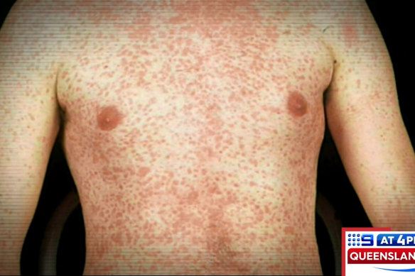 Measles symptoms include a blotchy red rash that often starts on the face before spreading.