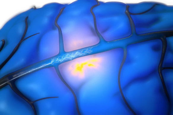 Synchron’s Stentrode microchip is pushed through a blood vessel into a patient’s brain via a catheter – where it can begin to pick up brainwaves.