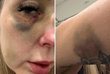 Wright was left with black eyes and a broken nose and says she struggles to breathe properly now.