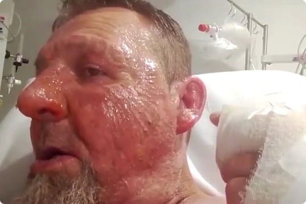 Randovan Banic, who was left with serious burns following an alleged petrol attack inside Prince of Wales Hospital.