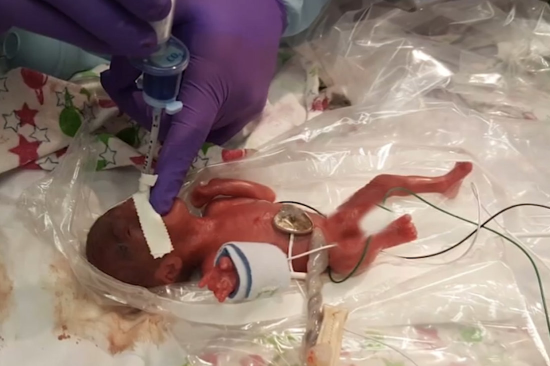 Amazing feat for world's smallest baby ever to survive.