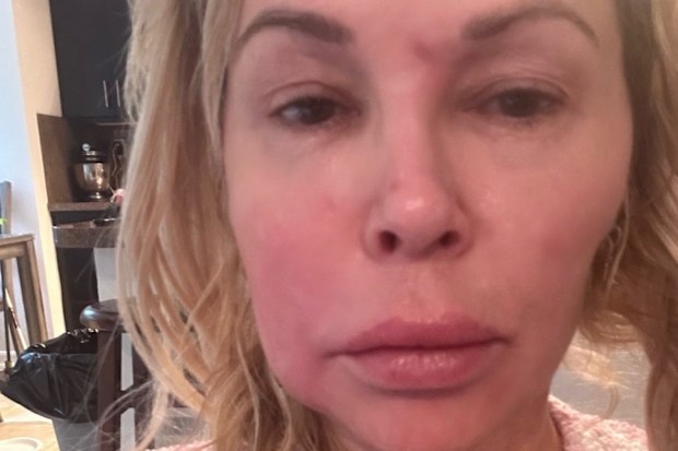 Brandi Glanville face disfigurement