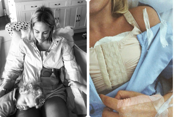 Phoebe Burgess opened up about her breast reduction surgery years after it happened in 2020.