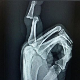 Ouch: An X-ray of Trent Merrin's dislocated finger.