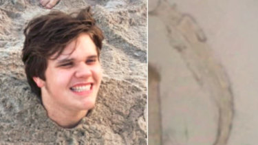 Michael Dumas, 17, got hookworm when his friends buried him in the sand at a Florida beach in June.