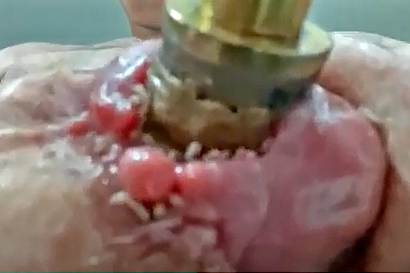 Still image from a video clip of maggots infesting Mark Urquhart’s wound where the metal bar emerges from the stump of his leg.