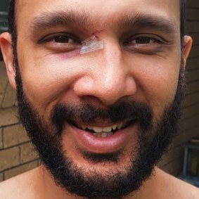 Gabba councillor Jonathan Sriranganathan sports a wonky nose after being punched by a stranger.
