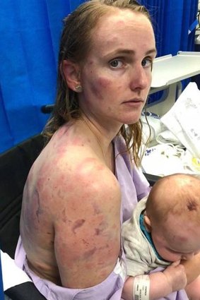 Kingaroy mother Fiona Simpson shielded her daughter as they were hammered by hail.