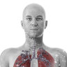 Silicosis explainer