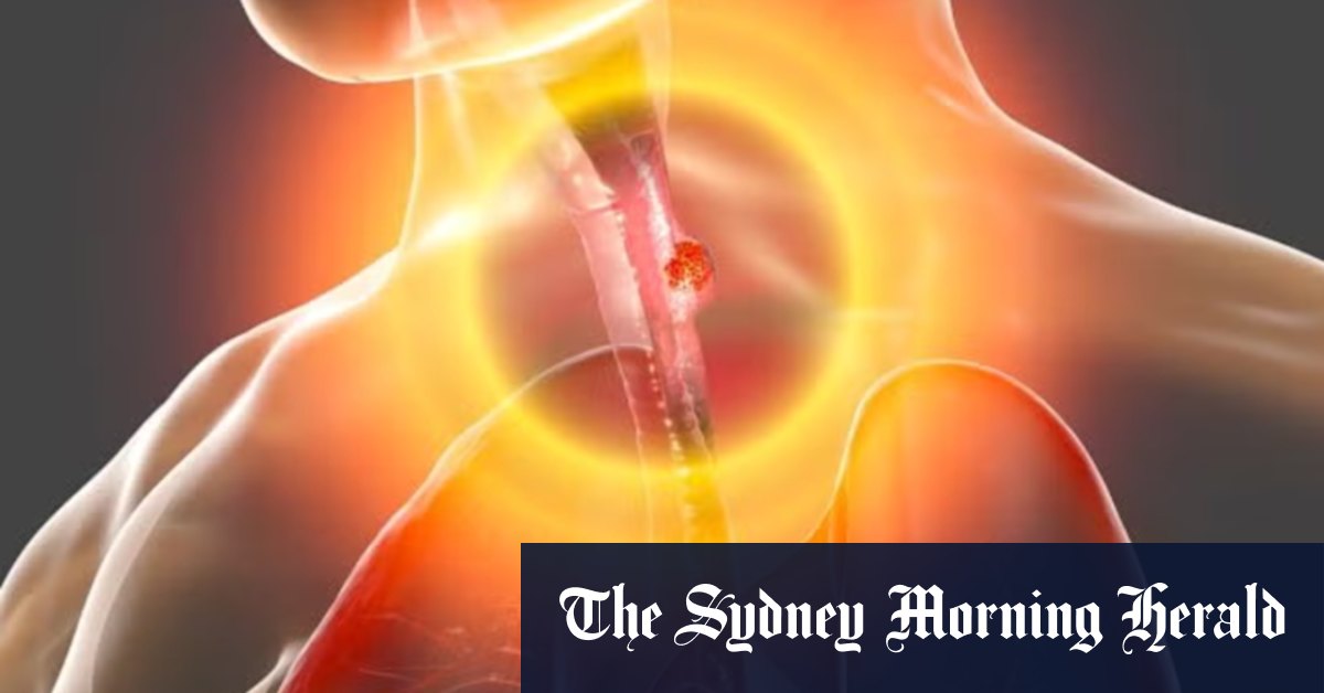 Proteomics makes blood test breakthrough for deadly throat cancer