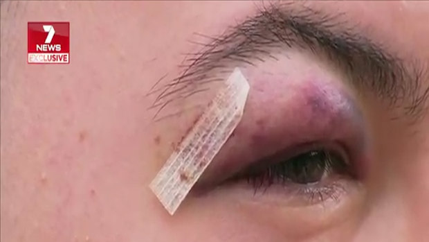 The 19-year-old man was glassed in the face with a beer bottle on Thursday night.