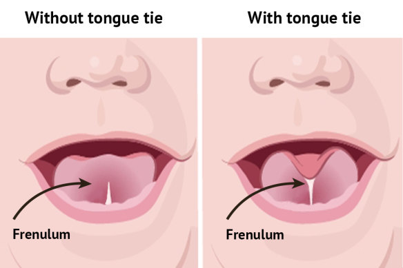 A diagram showing a baby with and without a tongue tie.