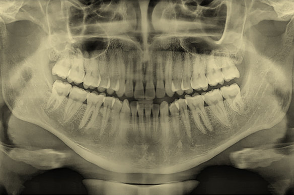 The roots of teeth extend into the upper and lower jawbones, as in this X-ray of adult teeth.