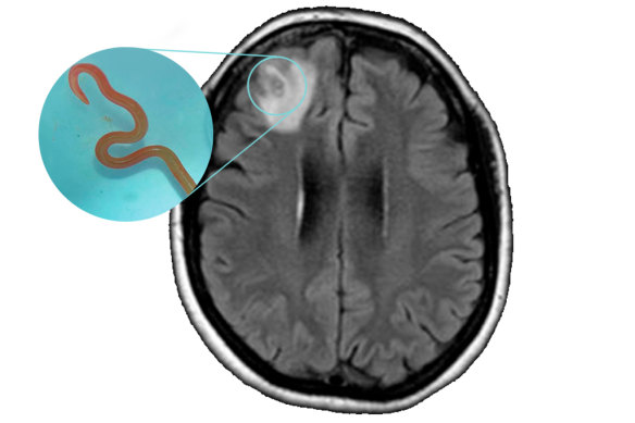 An MRI of the patient’s brain revealed a lesion at the front … that turned out to be a worm.