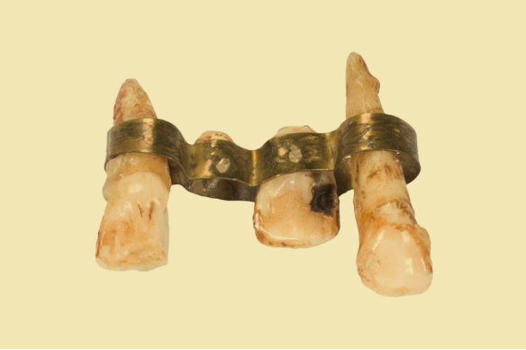 A copy of an Etruscan dental bridge, from 700-500BC, with three natural human teeth held in place by a riveted gold band.  