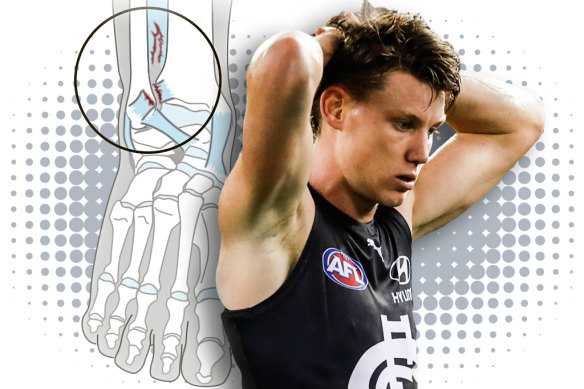 Sam Walsh has recently suffered a syndesmosis ankle injury.