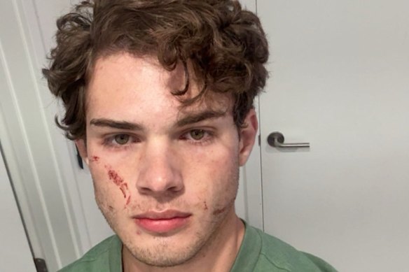 “That was brutal”: Influencer Clavicular appeared to confirm his night in hospital after a suspected overdose.