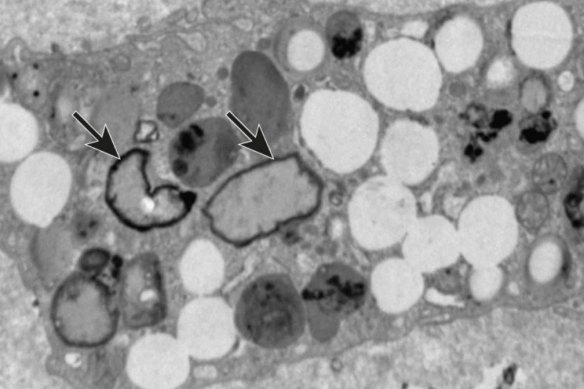 Microplastics (pointed out by arrows) within the cell of tissue removed from a study patient’s artery.