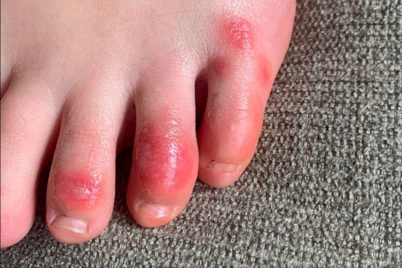 Discolouration on a teenage patient’s toes at the onset of the condition informally called “COVID toes”. 