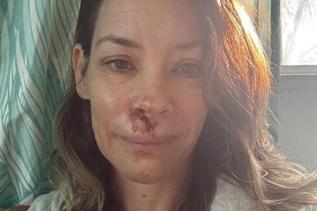 Evangeline Lilly traumatic brain injury