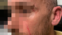 Mental health nurse James told nine.com.au he was attacked by a patient who tried to gouge his eyes out.