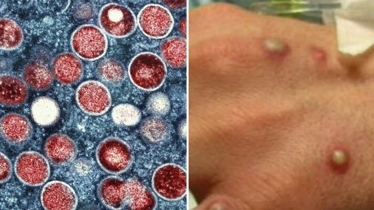 Mpox is a serious infectious disease.