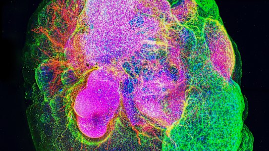 An example of a brain ‘organoid’ – a bundle of human tissue grown in the lab from stem cells. Researchers from Queensland studied organoids to screen drugs that can flush out damaging ‘zombie cells’ from brain tissue.
